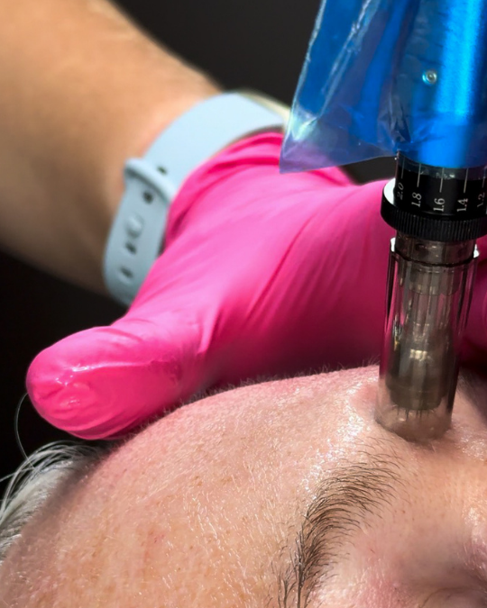 microneedling bona vie medical spa idaho falls