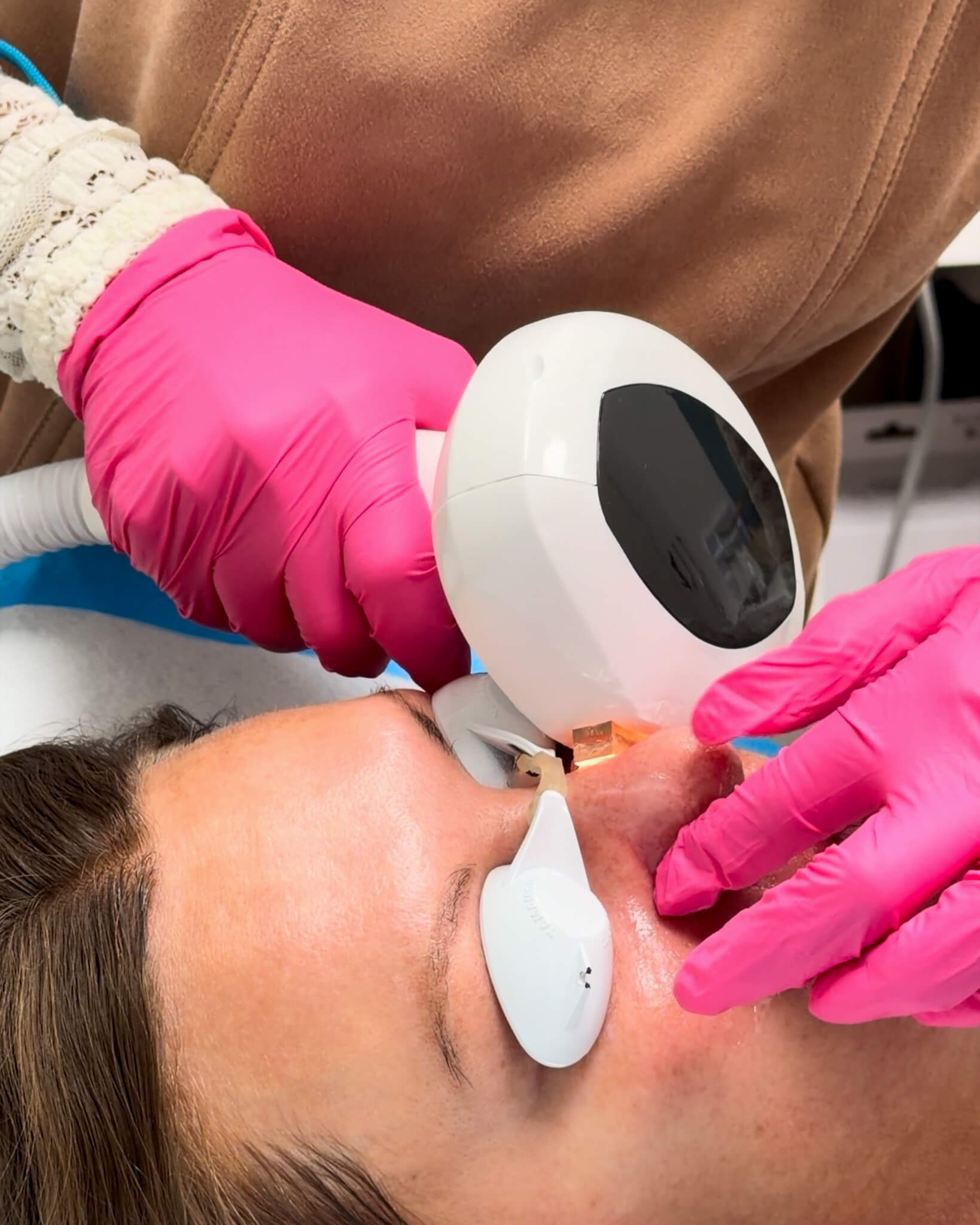 lumecca ipl bona vie medical spa idaho falls sun damage pigmentation skin treatment