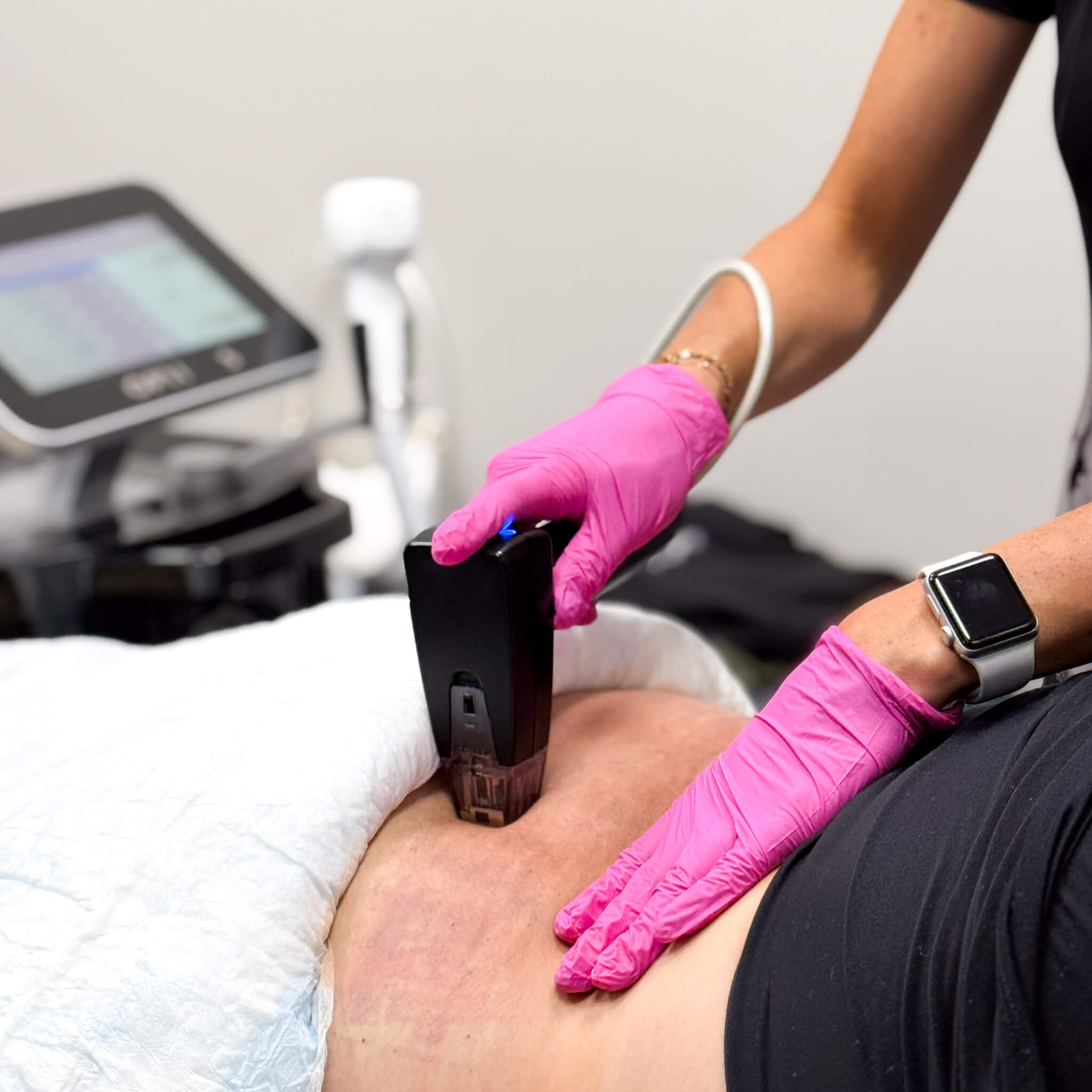 Morpheus8 Body skin tightening idaho falls med spa remodeling