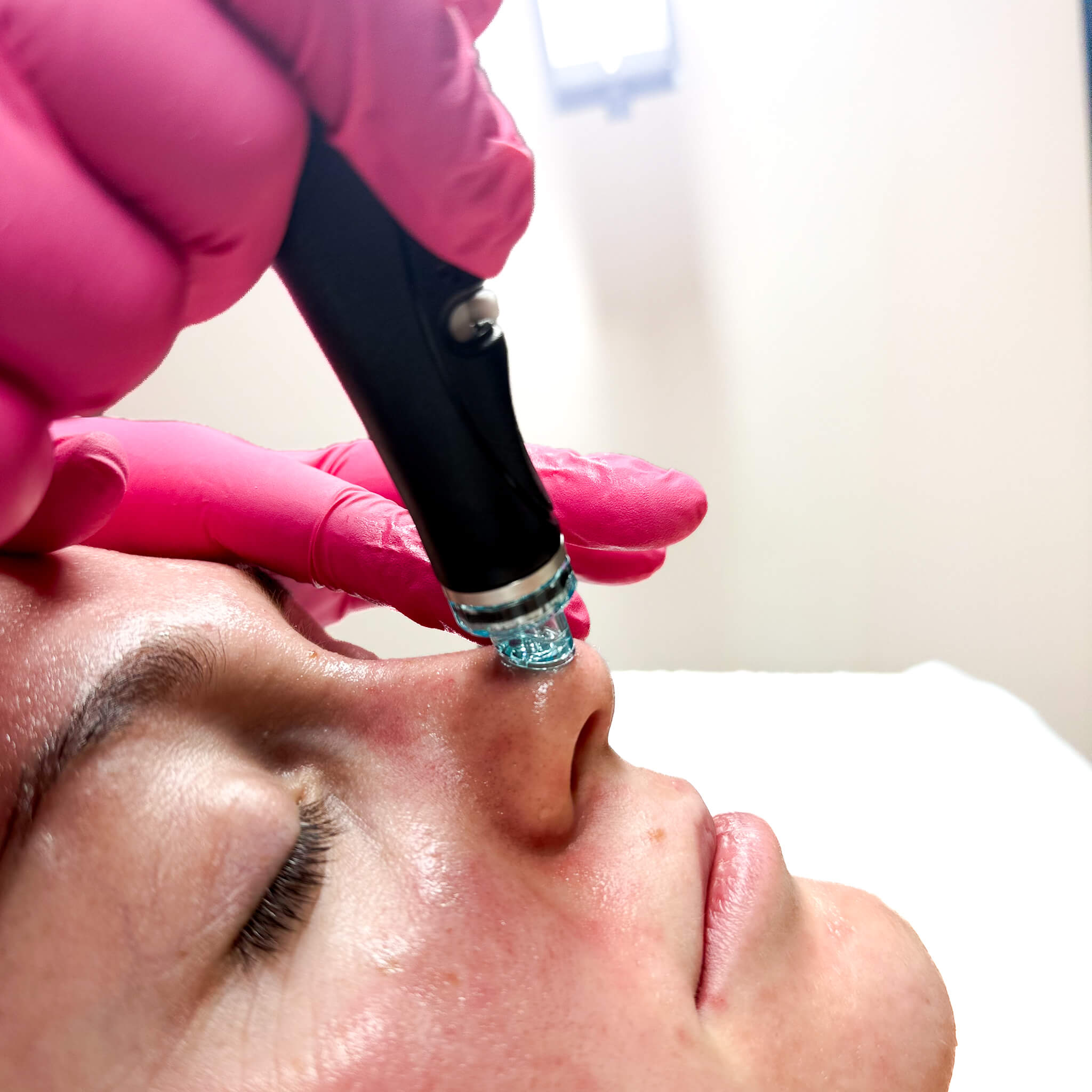 hydrafacial clogged nose pores med spa idaho falls 