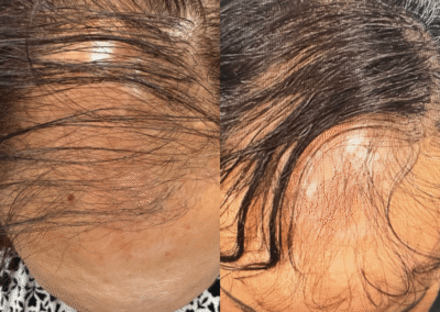 Microneedling PRP Scalp Injection hair loss treatments idaho falls bona vie medical spa