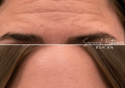 botox tox injections injectables idaho falls bona vie medical spa