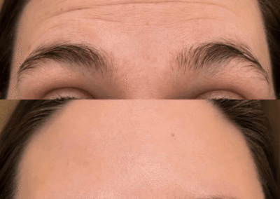 botox tox injections injectables idaho falls bona vie medical spa