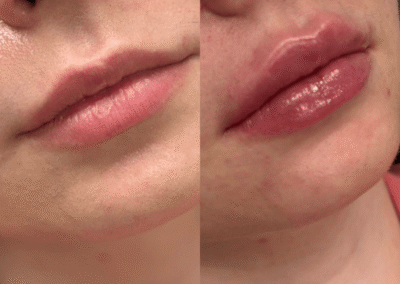 Lip dermal fillers enhancement before after results idaho falls bona vie medical spa